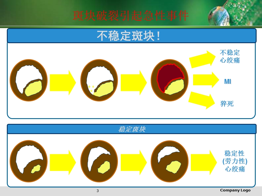 急性心梗诊断治疗新视点课件.ppt_第3页