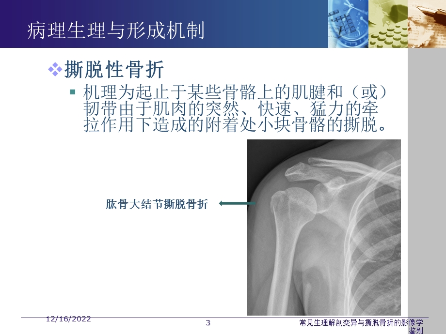 常见生理解剖变异与撕脱骨折的影像学鉴别培训课件.ppt_第3页