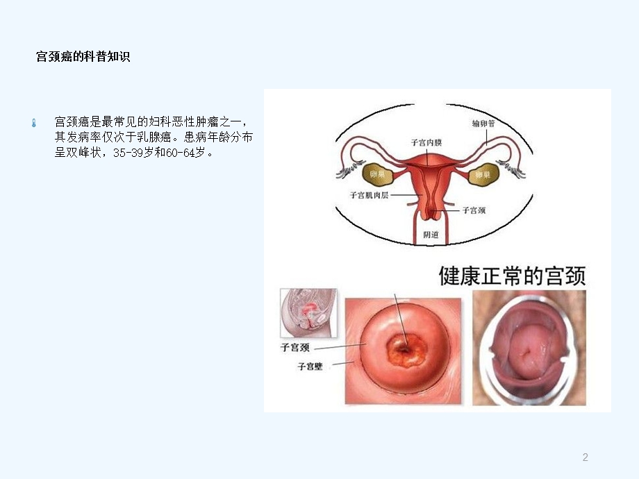 宫颈癌广泛性子宫切除盆腔淋巴结清扫手术配合课件.ppt_第2页