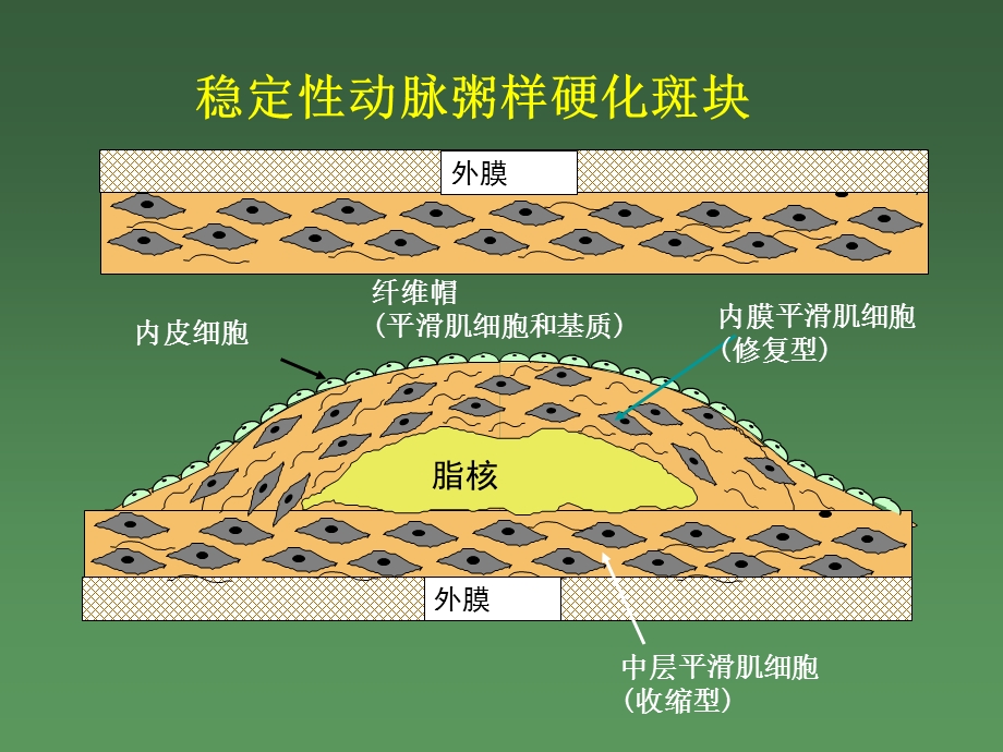 急性冠脉综合征心电图课件.ppt_第2页