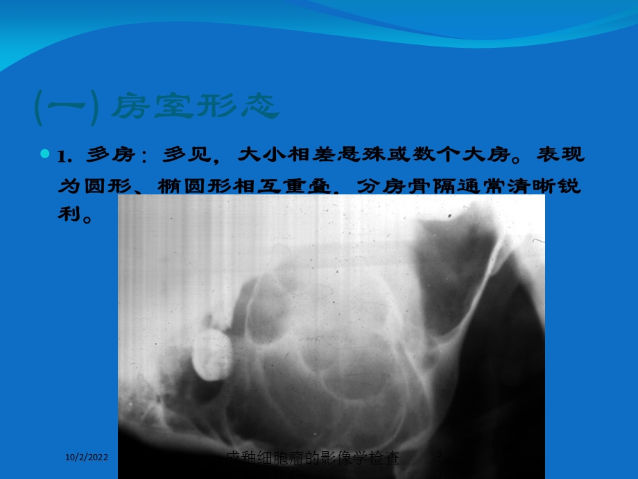 成釉细胞瘤的影像学检查和鉴别诊疗培训课件.ppt_第3页