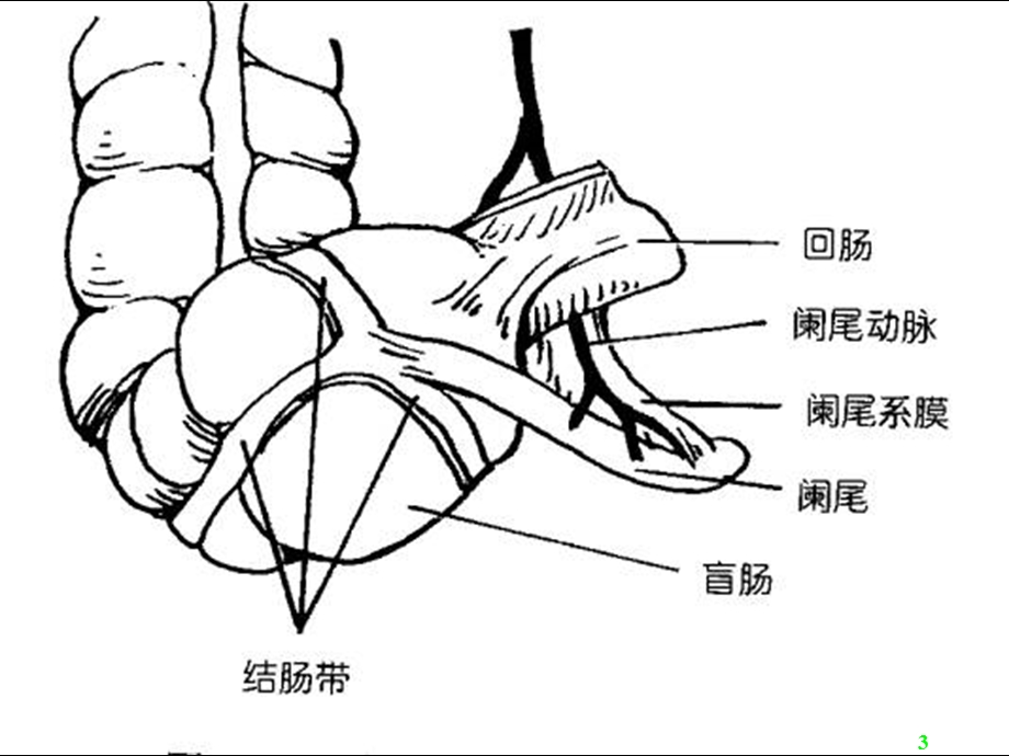 急性阑尾炎一点通课件.ppt_第3页