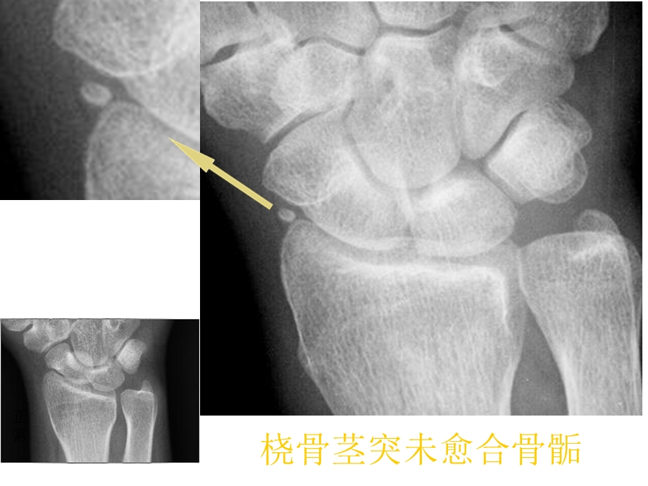 易误认为骨折的骨骺张晓春医学课件.ppt_第2页