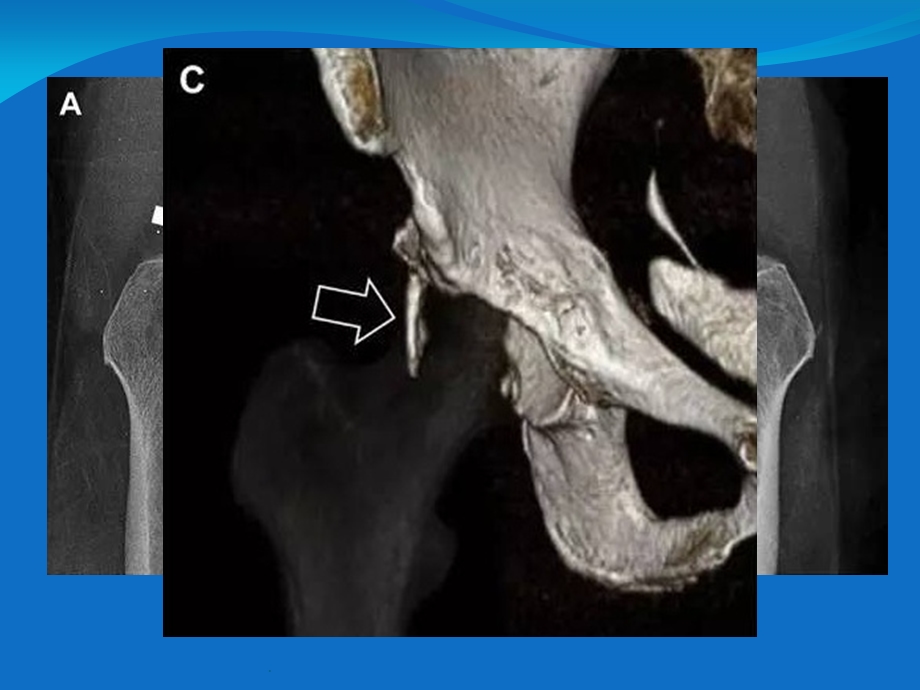 放射科医生千万不要漏诊的36种骨折课件.ppt_第3页
