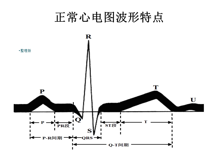 常见异常心电图的识别及处理.ppt_第3页