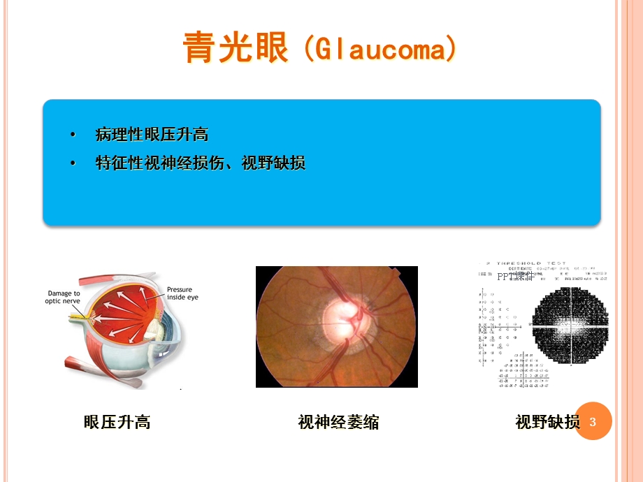 急性闭角型青光眼课件.ppt_第3页