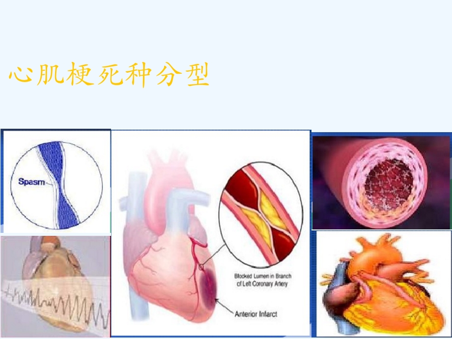 急性心肌梗死的溶栓治疗教学查房课件.ppt_第3页