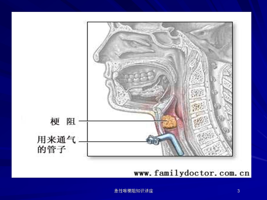 急性喉梗阻知识讲座培训课件.ppt_第3页