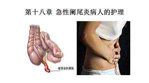 急性阑尾炎病人的护理ppt课件.pptx