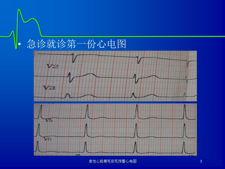 急性心肌梗死猝死预警心电图培训课件.ppt_第3页