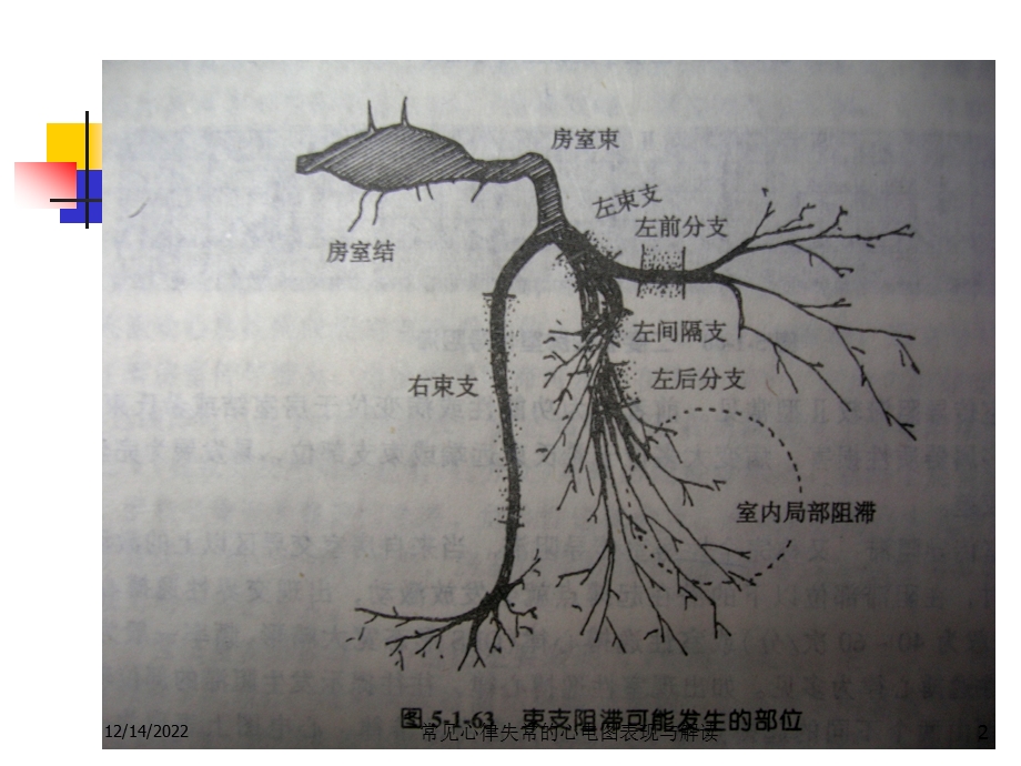 常见心律失常的心电图表现与解读培训课件.ppt_第2页