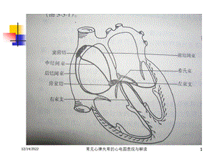 常见心律失常的心电图表现与解读培训课件.ppt