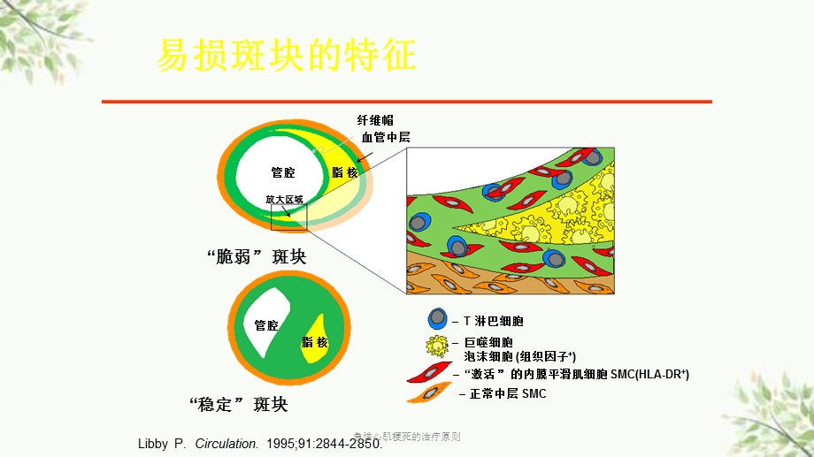 急性心肌梗死的治疗原则课件.ppt_第3页