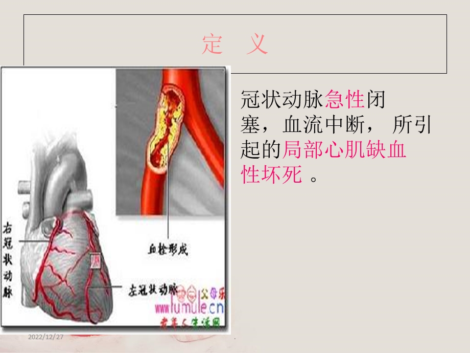 急性心肌梗死的护理查房版本课件.ppt_第3页