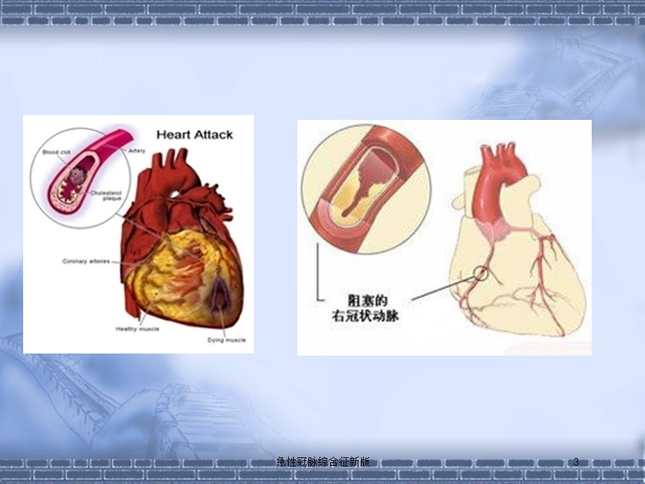 急性冠脉综合征新版培训课件.ppt_第3页