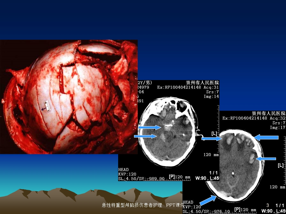 急性特重型颅脑损伤患者护理课件.ppt_第3页