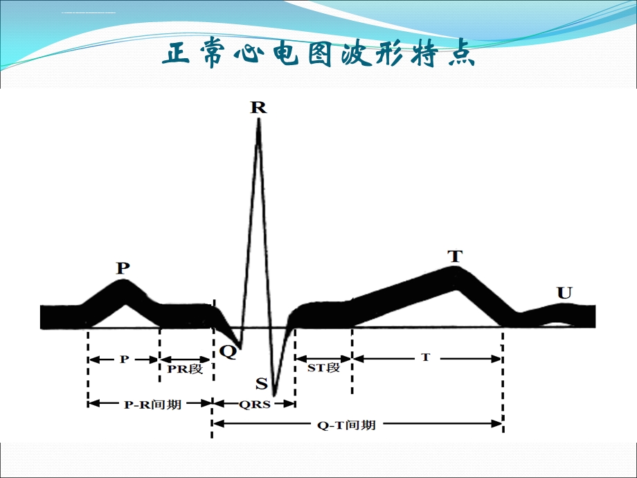 常见异常心电图的识别及处理ppt课件.ppt_第3页