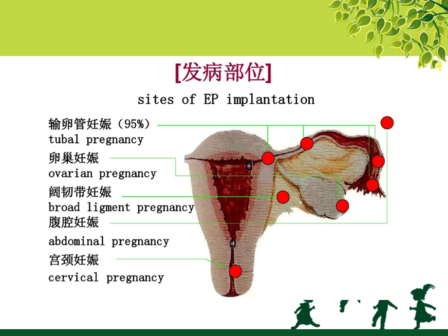 宫外孕专业知识讲座课件.ppt_第2页