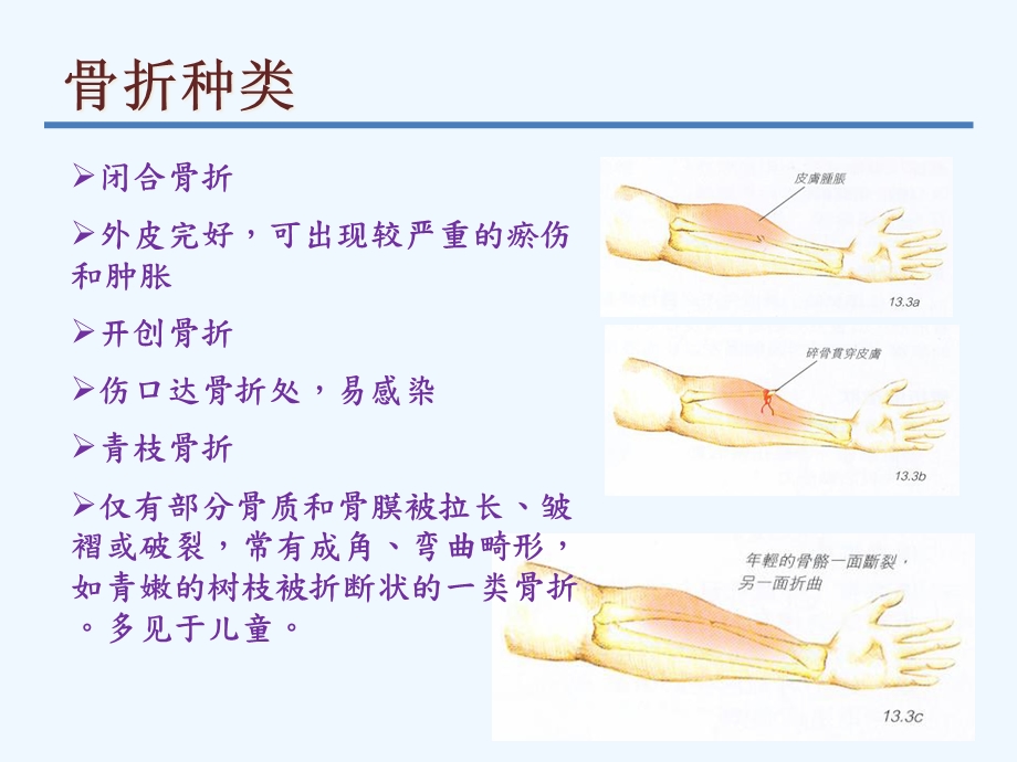 急救骨折急救处理与搬运课件.ppt_第3页