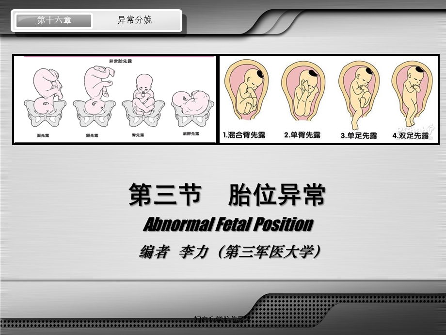 妇产科学胎位异常培训课件.ppt_第2页