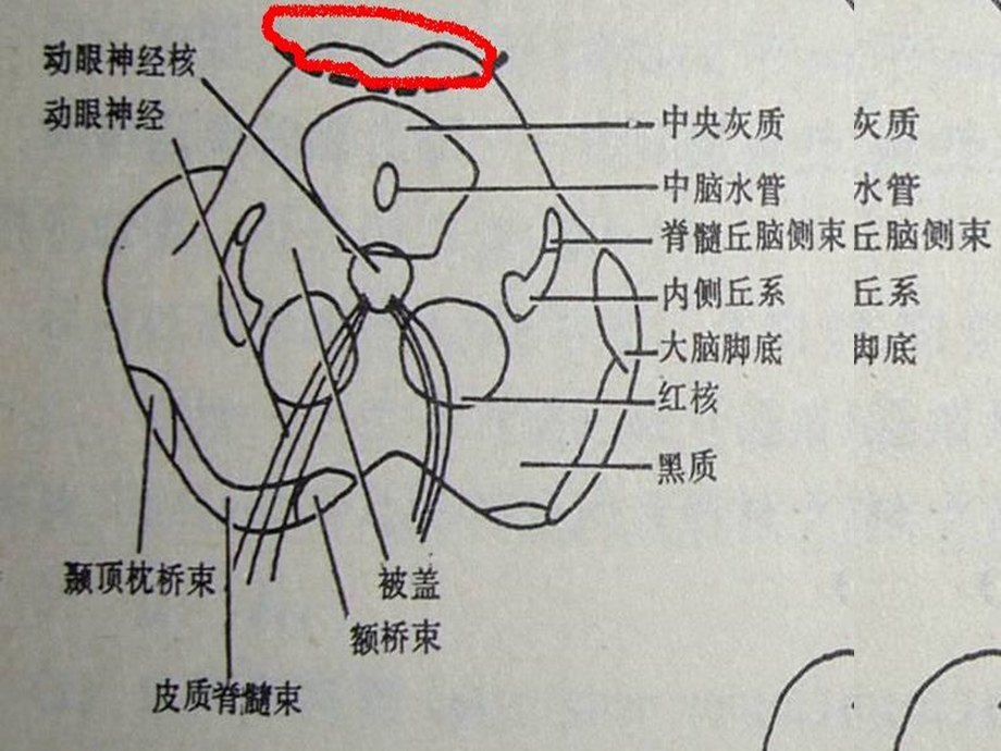 常见脑干损害综合征课件.ppt_第3页