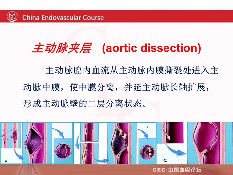 急性主动脉夹层etvar术的临床疗效分析 苏晞课件.ppt_第2页