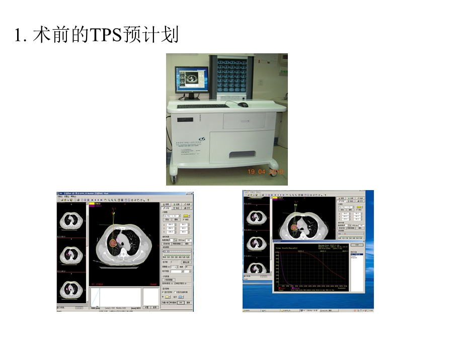 放射性粒子治疗肿瘤的管理与质量控制.pptx_第3页