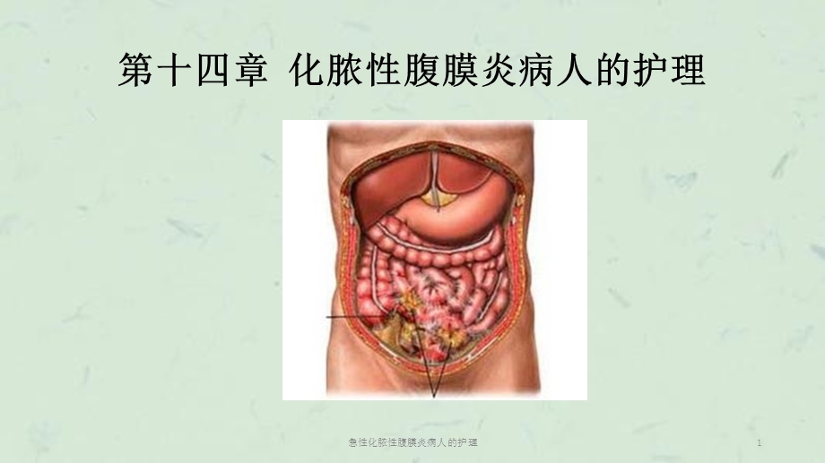 急性化脓性腹膜炎病人的护理课件.ppt_第1页