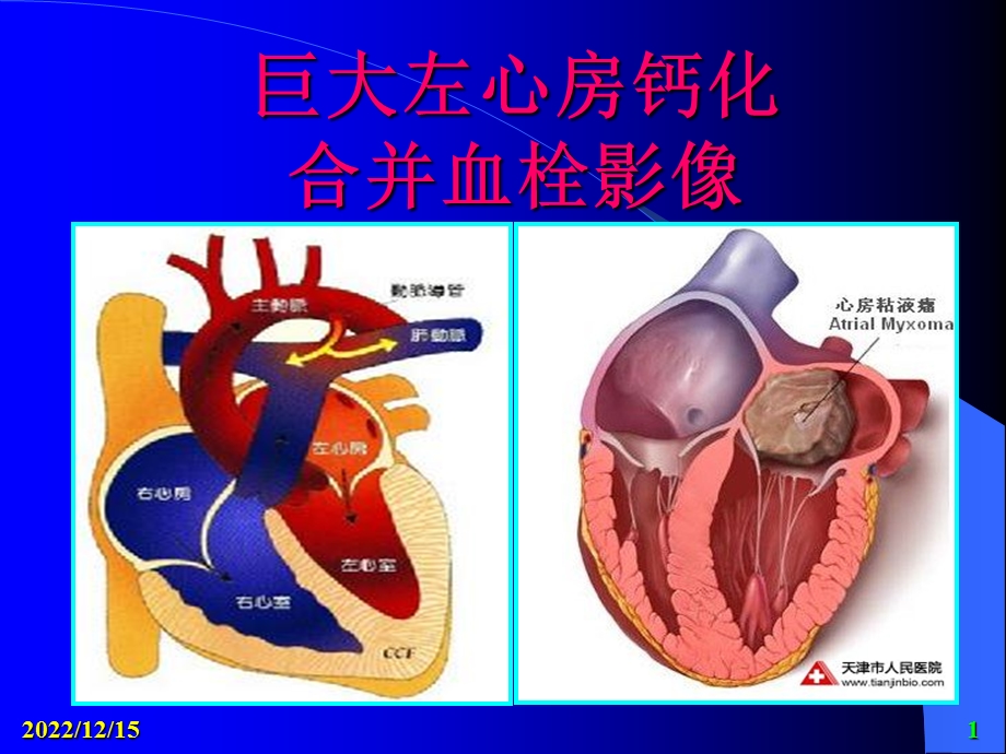 巨大左心房钙化合并血栓影像课件.pptx_第1页