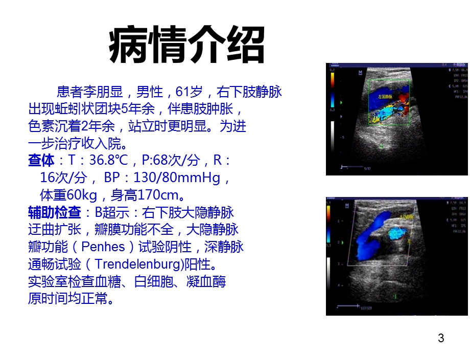 大隐静脉曲张护理查房课件.pptx_第3页