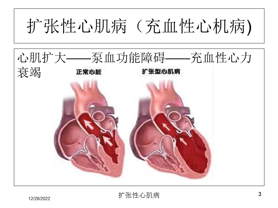 扩张性心肌病培训课件.ppt_第3页