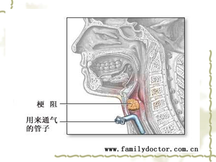 急性喉梗阻的护理ppt课件.ppt_第3页