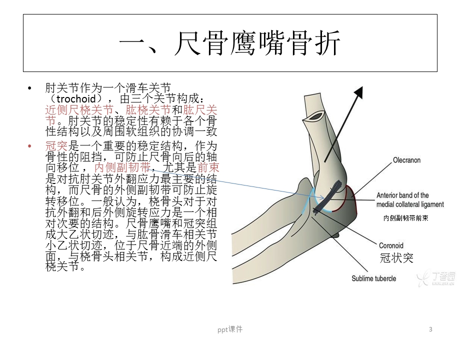 尺骨近端骨折课件.ppt_第3页