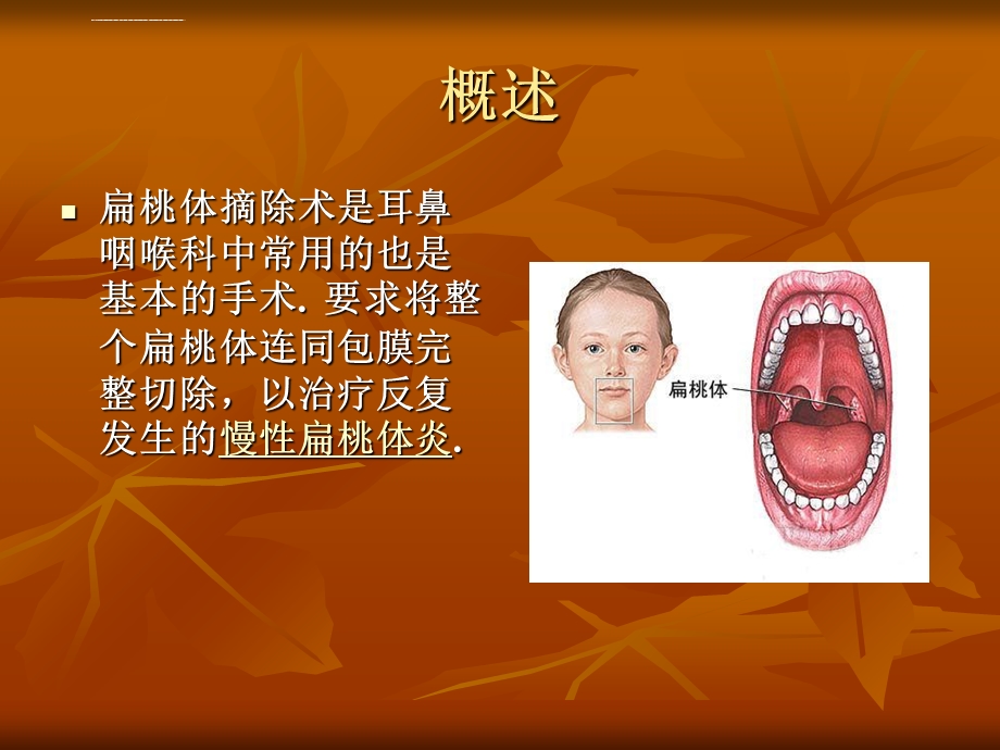 扁桃体切除术围手术后的护理ppt课件.ppt_第2页