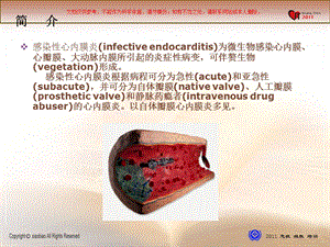 感染性心内膜炎诊治现状课件.ppt