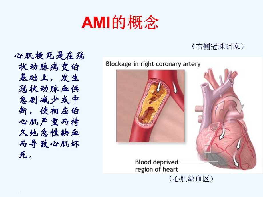 急性心肌梗死院前急救护理进展课件.ppt_第3页