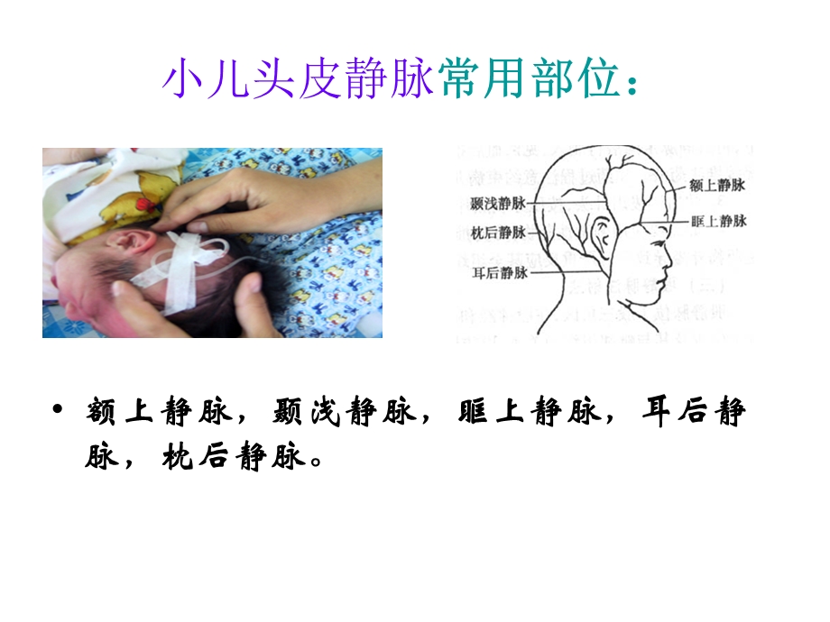 小儿头皮静脉ppt课件.ppt_第2页