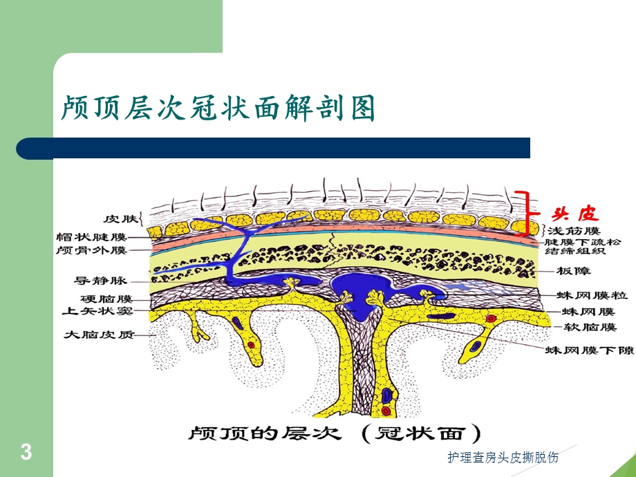 护理查房头皮撕脱伤培训课件.ppt_第3页