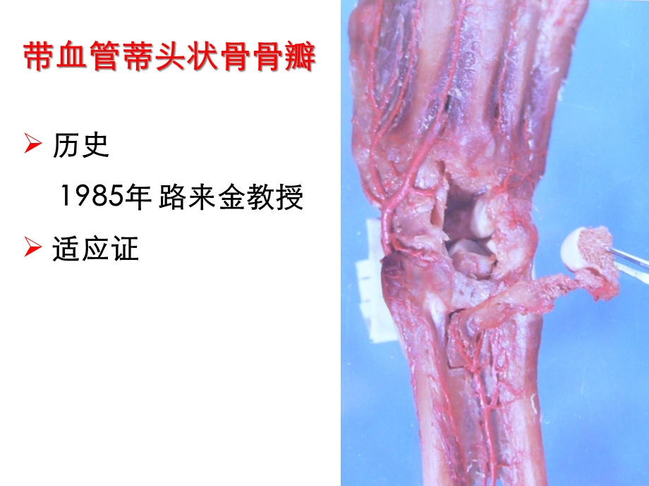 带血管蒂头状骨骨瓣治疗晚期课件.ppt_第2页