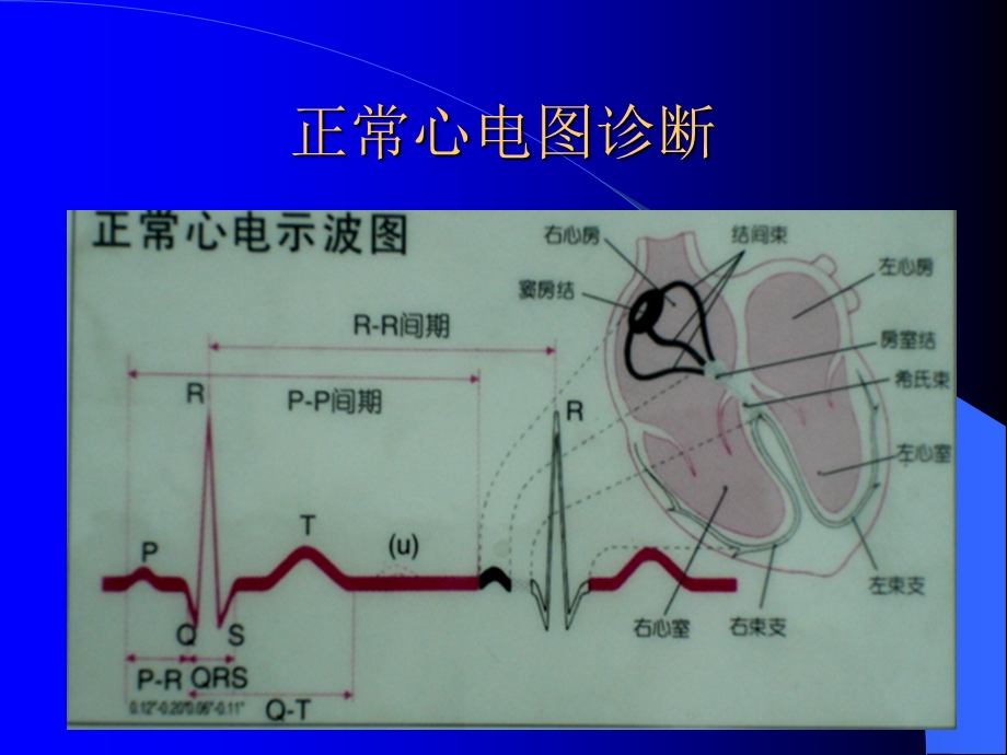 常见异常心电图诊断ppt课件.ppt_第3页