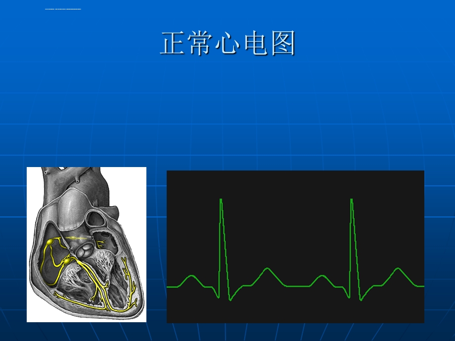 恶性心律失常的诊断及电复律ppt课件.ppt_第2页