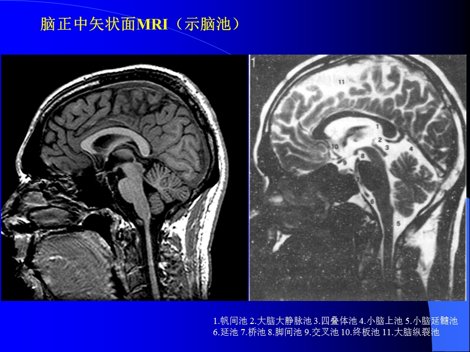 断层解剖脑池脑血管课件.ppt_第3页