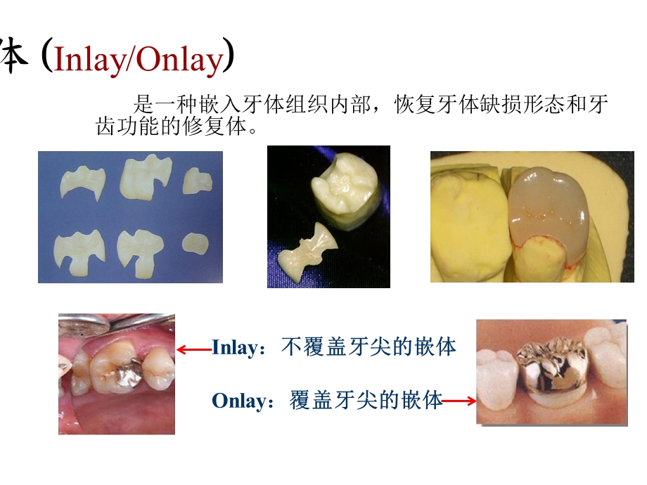 嵌体的制作方法和分类课件.ppt_第3页