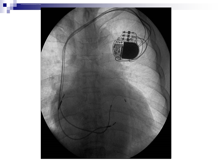 心脏起搏器ppt课件.ppt_第3页
