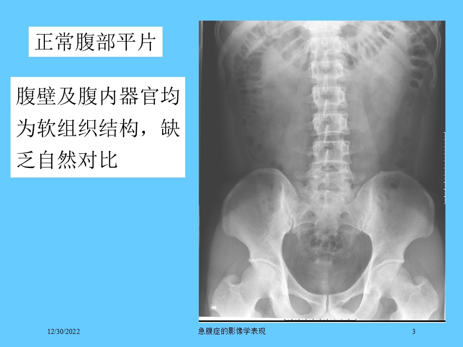 急腹症的影像学表现培训课件.ppt_第3页