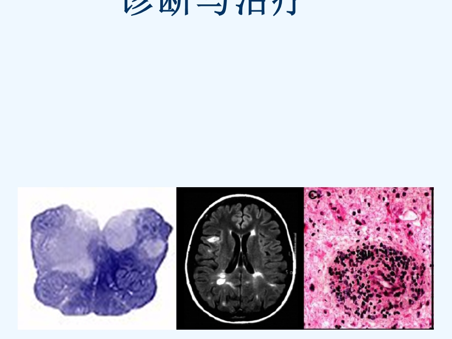 多发性硬化诊断与治疗课件.ppt_第1页