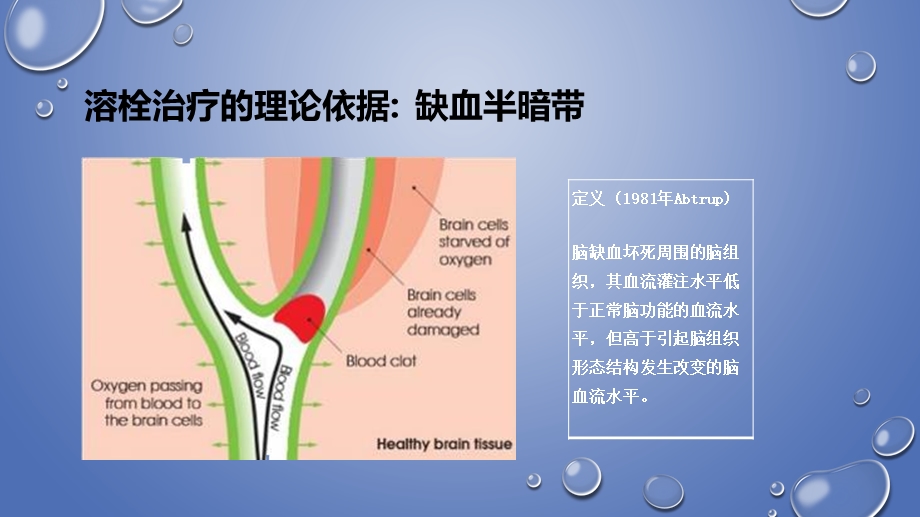 急性缺血性卒中的静脉溶栓治疗ppt课件.pptx_第3页