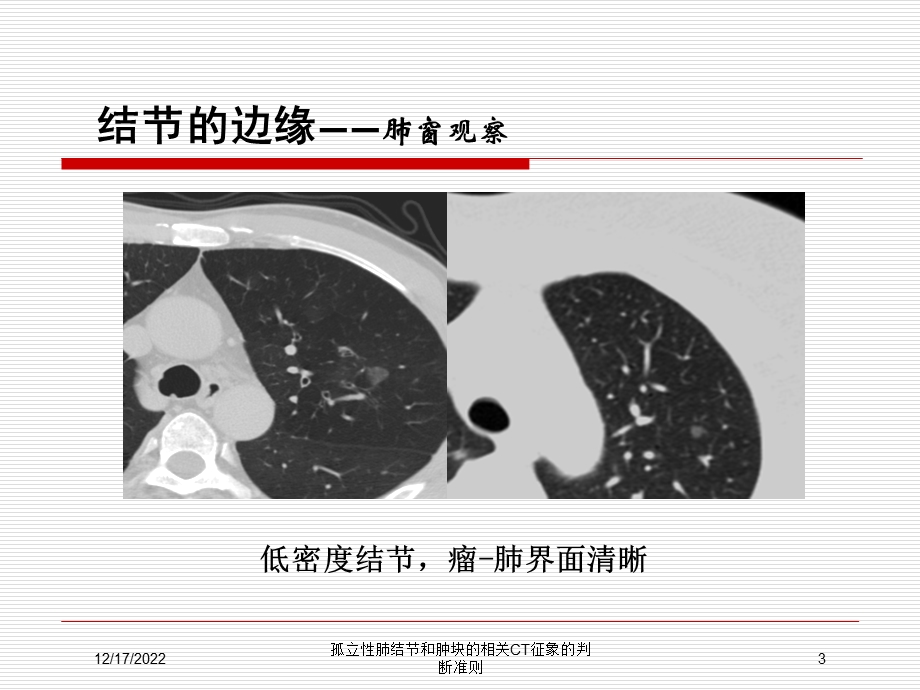 孤立性肺结节和肿块的相关CT征象的判断准则课件.ppt_第3页