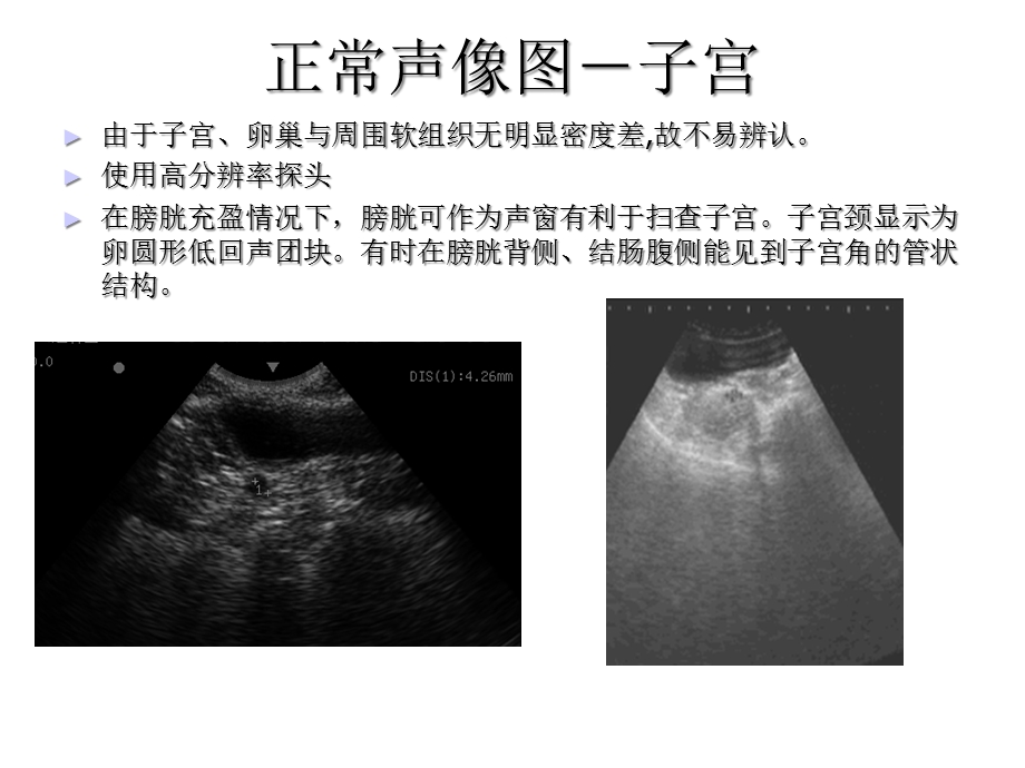 子宫以及卵巢检查.ppt_第3页