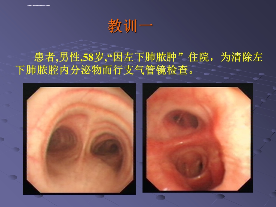 支气管镜诊疗相关大咯血的预防与救治ppt课件.ppt_第2页